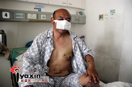 新疆沙灣村民山中撿玉遭棕熊攻擊 鼻子、上嘴唇被咬掉撿回一命（圖）