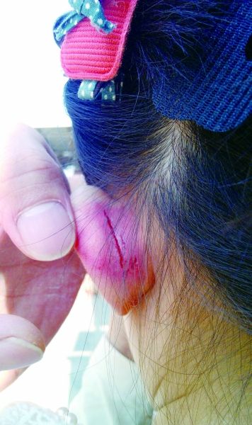 　　女童的耳朵被老師揪裂。圖片由女童家人提供