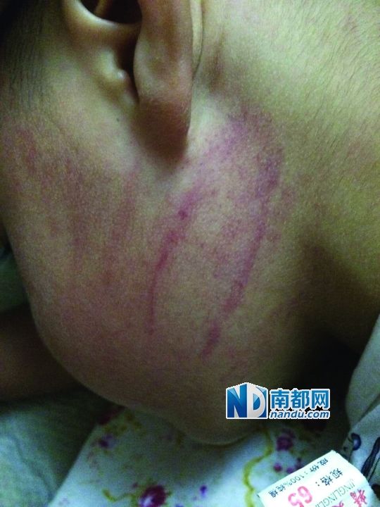 小逸臉上淤痕清晰可見(jiàn)。