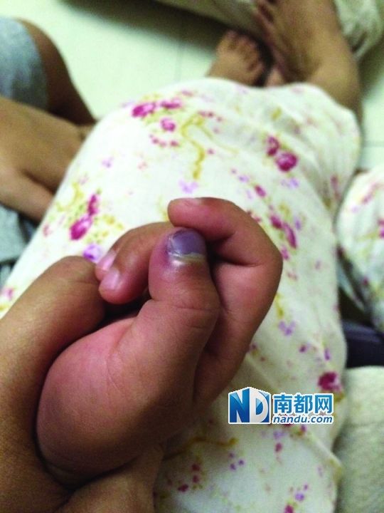 小逸手指被夾傷。