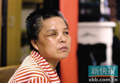 4月初,趙女士遭人搶劫并被打傷,現(xiàn)今右眼失明,頭部被縫100多針。記者 畢志毅/攝