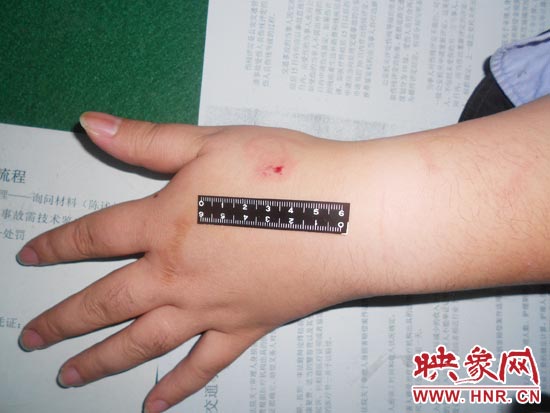 為幫助無證駕駛的朋友逃避處罰，新鄉(xiāng)的王某竟對(duì)執(zhí)勤民警大打出手，還將一名民警的手臂咬傷