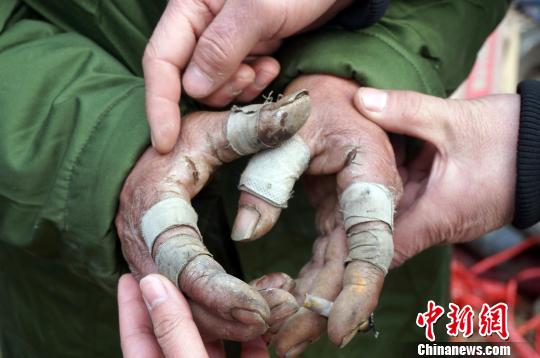 圖為由于常年拾荒，老人雙手布滿傷口。周小云 攝