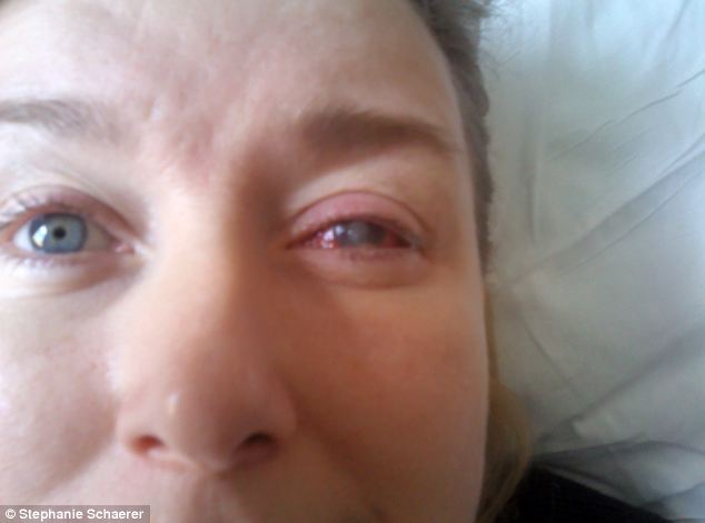 恐怖慎入！隱形眼鏡致英女子摘除眼球