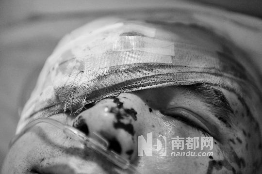 李建新頭部還有被潑硫酸的痕跡，醫(yī)生說被砍傷的右眼已經(jīng)失明。 南都記者 田飛 攝