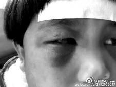 6月2日，網(wǎng)曝渭南市臨渭區(qū)一不滿5歲的女童遭奶奶毆打，眼圈青腫，引起網(wǎng)友關(guān)注，但孩子父母和爺爺均稱是摔倒導(dǎo)致。相關(guān)部門介入調(diào)查發(fā)現(xiàn)確為奶奶毆打所致，鑒于其身體原因已進(jìn)行批評教育。
