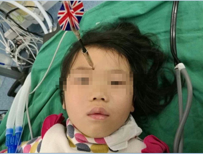 十多公分長(zhǎng)的飛鏢穩(wěn)穩(wěn)地 ” 定 ” 在了一名六歲半的女童額頭上，小青一家人凌晨從長(zhǎng)順趕到貴醫(yī)附院急診室時(shí)，看到如此慘烈的情況，接診醫(yī)生都嚇了一跳。詳細(xì)詢問(wèn)下得知，原來(lái)是七歲的哥哥和六歲半的表妹在玩耍時(shí)，哥哥不慎將路邊撿來(lái)的真飛鏢扎到了妹妹的額頭上。