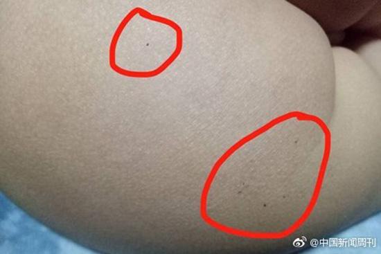 據(jù)多名紅黃藍(新天地分園)家長反映，孩子腿部、屁股、腋下出現(xiàn)針眼。