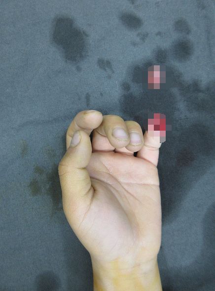 嚇哭！6歲男孩被夾斷手指 罪魁禍首竟是校服