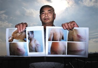 王維龍出示在張家口被關時被虐受傷的照片。