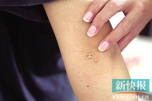 取出針后李星兒手臂留下了傷口。新快報(bào)記者 張國鋒/攝