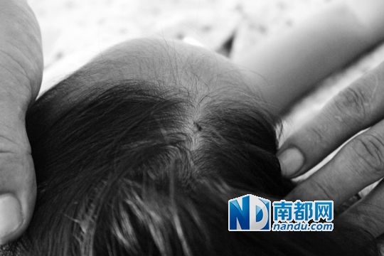 女童頭上被扎的針孔（圓圈處）。賈先生說(shuō)，被扎不到三秒鐘，女兒就昏了。