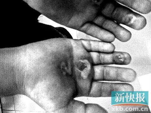 廣州一男孩被學(xué)長(zhǎng)用煙頭燙爛手掌 踢傷下體(圖)