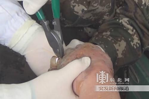 正在拆除戒指。