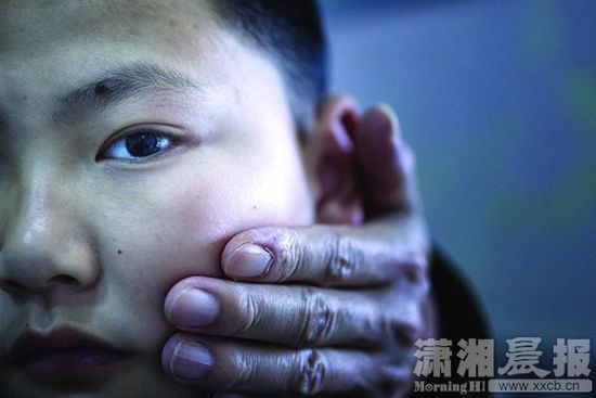 1月13日，小玨的父親心疼地摸著兒子的臉。