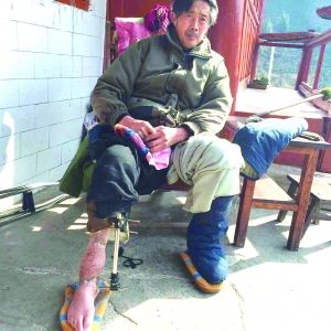 關(guān)某右小腿萎縮 關(guān)某右小腿萎縮