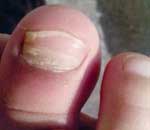 一幼兒園兒童“指甲異?！? title=